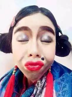 媒婆痣太苦恼,激光点痣为我化解尴尬
