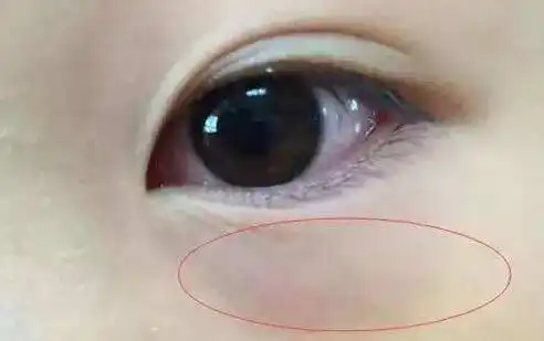 2个小妙招轻松去黑眼圈,再也不做熊猫眼