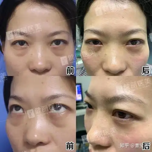 工作经常熬夜要怎么消除黑眼圈和眼袋
