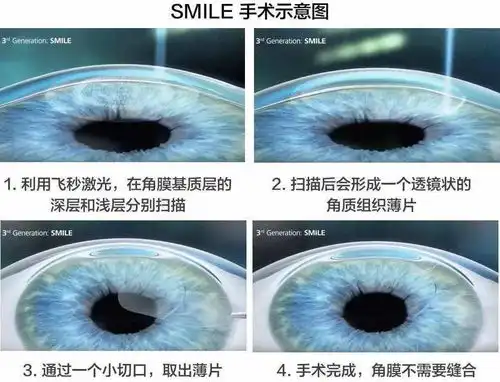 视力跟中考挂钩,萧山妈妈想让孩子去做手术近视手术到底该不该做萧山资深眼科医生来解答
