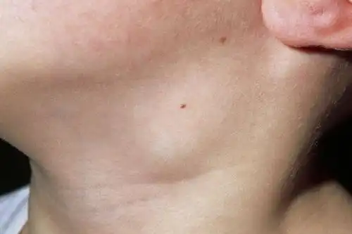 淋巴癌的图片