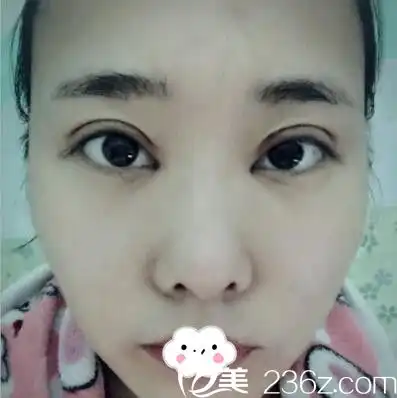 双眼皮恢复记天津欧菲李文祥做的双眼皮开眼角术后效果让我貌美如花