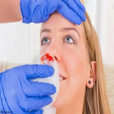 鼻子出血是怎么回事鼻子出血6原因很复杂

