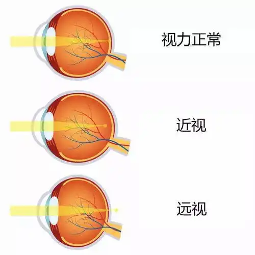 2022征兵即将开始,郑州尖峰眼科助您实现军旅梦
