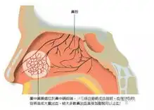 春天孩子易出鼻血怎么办