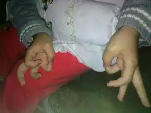 孩子手痒痒,这是什么原因
