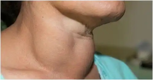 甲状腺癌发生率增长迅猛颈部彩超可查出早期症状
