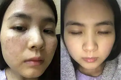 熬夜追剧黑眼圈,久看手机眼干涩每天1袋花青素,名目又养颜
