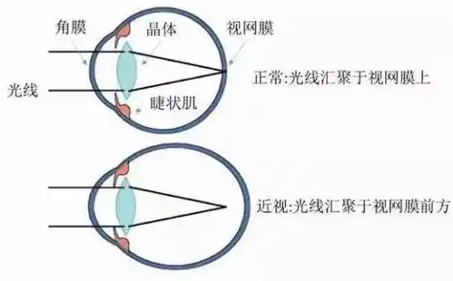 全飞秒是如何让近视飞走的

