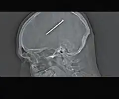 盘点奇迹坚强帝铁钉穿心子弹穿额大难不死
