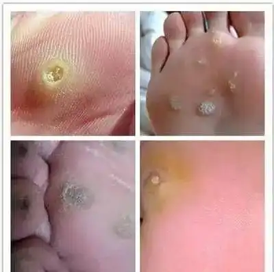 健康皮肤科医生的战疣术,教你如何消灭足底的小恶魔
