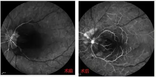 视网膜中央动脉阻塞复通,福州爱尔眼科医院实现新技术新突破
