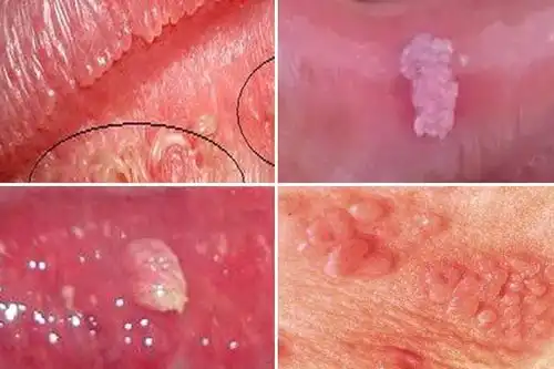 身上长的小菜花让我们再认识尖锐湿疣,不要让它毁了你一生的幸福
