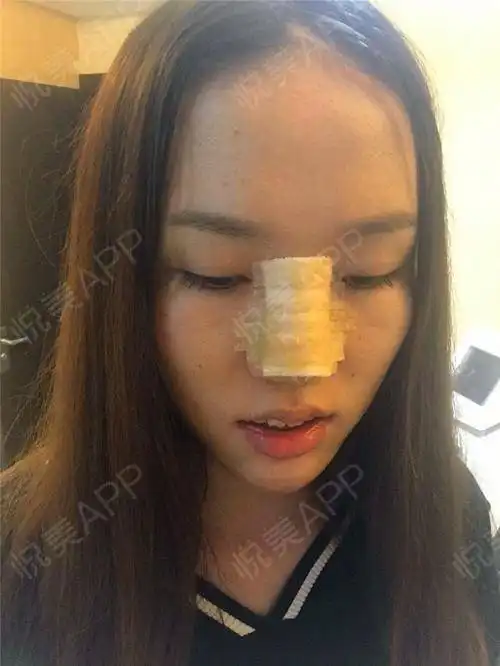 鼻子已经做好了,不过还看不到效果,包的满满的都是纱...垫鼻尖悦美整形