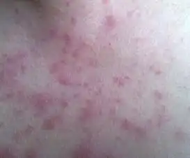 皮肤红斑狼疮早期症状是什么样的
