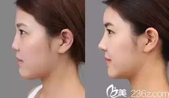 哈尔滨大直超龙医院隆鼻好不好黑龙江超龙隆鼻真人案例隆鼻优势介绍以及最新价格表