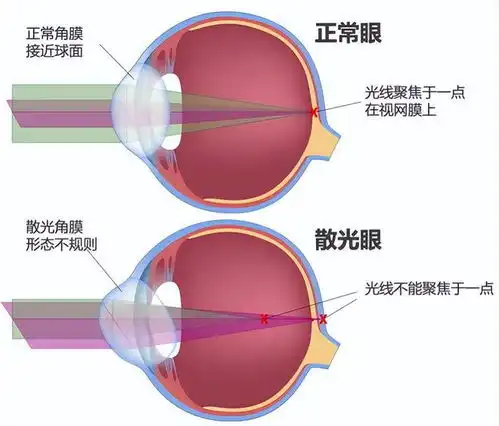 散光的原理和形成原因为什么会散光
