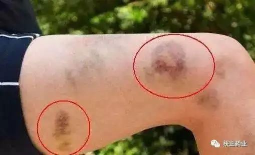 中药治疗癌症痛苦
