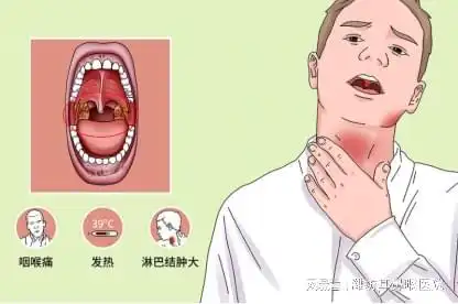 扁桃体发炎的症状揭秘为什么会嗓子疼咽喉红肿
