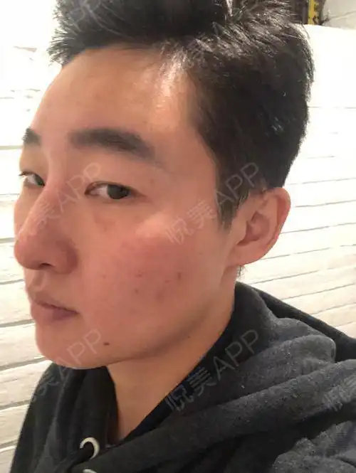 鼻小柱出血痂已全部脱落,未留下疤痕鼻孔内腔血痂也...垫鼻尖悦美整形