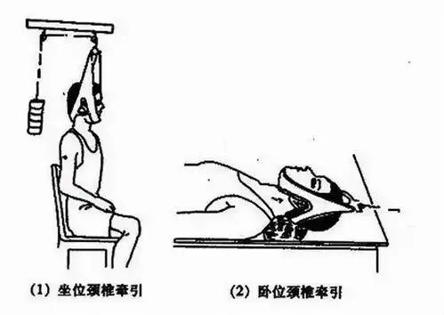 公园大爷在单杠上吊,竟是为了治疗颈椎病
