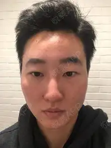 鼻小柱出血痂已全部脱落,未留下疤痕鼻孔内腔血痂也...垫鼻尖悦美整形