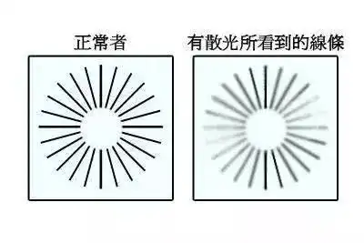 散光和近视可以一同矫正360全晰定制告诉你可以
