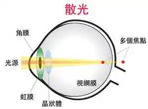 了解近视眼的形成原因以及眼睛的工作原理
