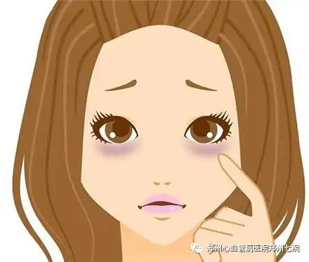 搞清不同类型的黑眼圈,远离熊猫眼

