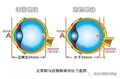 戴近视眼镜和眼球凸出有关系吗
