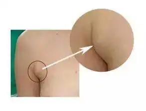 副乳只是腋下的两坨赘肉细数副乳的10大危害

