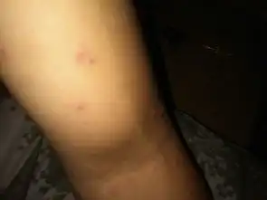 手臂上长了很多小红点,但是没我水泡,是不是艾滋病初期症状,真的好害怕
