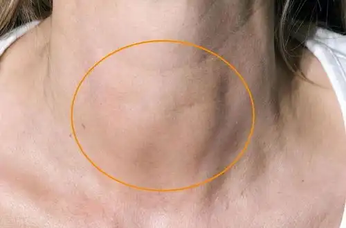 长期出现这些症状,小心甲状腺炎做好早期预防,及时筛查
