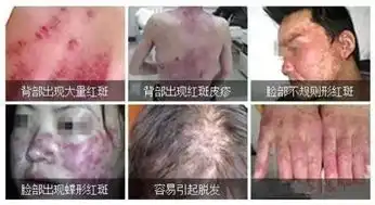 红斑狼疮的营养调理
