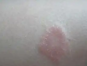 红斑狼疮症状表现是什么
