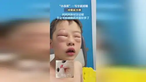 小孩哥一写字就揉眼一揉眼就水肿妈妈笑称对字过敏

