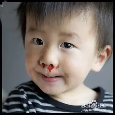 为什么突然流鼻血