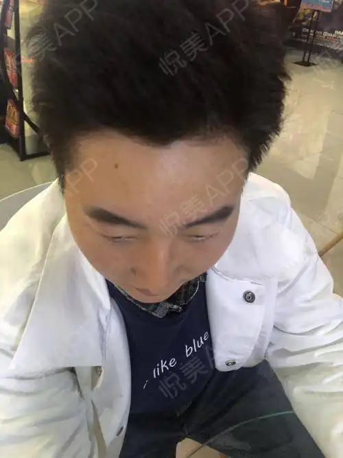 鼻小柱出血痂已全部脱落,未留下疤痕鼻孔内腔血痂还...垫鼻尖悦美整形