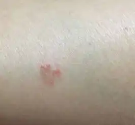 皮肤上有小红点是什么有图片
