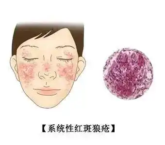 10种症状可能是红斑狼疮的表现
