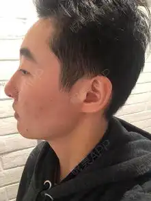 鼻小柱出血痂已全部脱落,未留下疤痕鼻孔内腔血痂也...垫鼻尖悦美整形