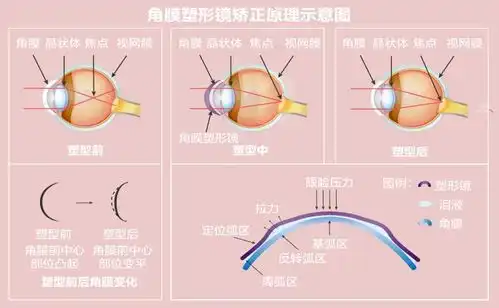晒眼皮转眼球能逆转近视吗了解近视的科学矫正
