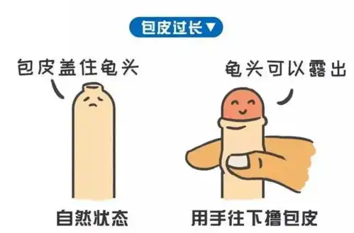 被束缚的小鸡鸡,割or不割先搞清楚再下手
