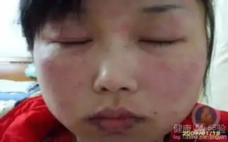 红斑狼疮的早期症状
