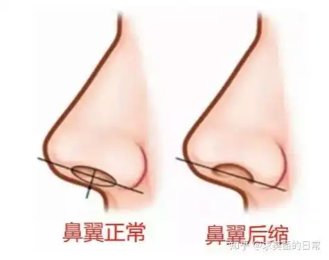 鼻子流血表情包鼻孔