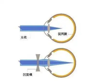 呐兔让你认清孩子眼轴变长的隐患,为了他的未来赶紧做好视力工作
