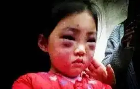 株洲宝宝从床上摔下现熊猫眼,这些情况家长一定要警惕
