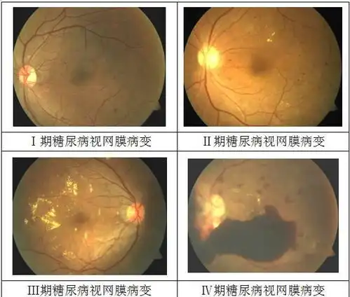 糖尿病不可怕,糖尿病的亲戚朋友最可怕
