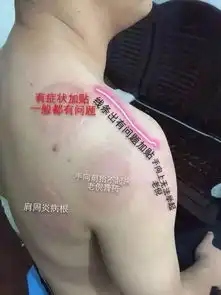 老倪膏药各部位症状及的贴敷方法
