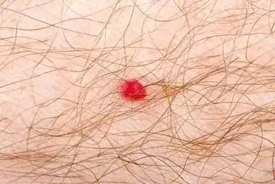 艾滋病脚红斑早期图片,痒不痒都得注意
